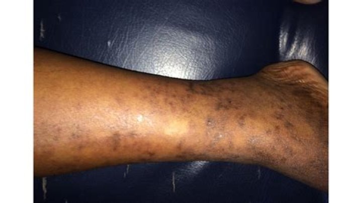 Can you die from Livedo Reticularis?