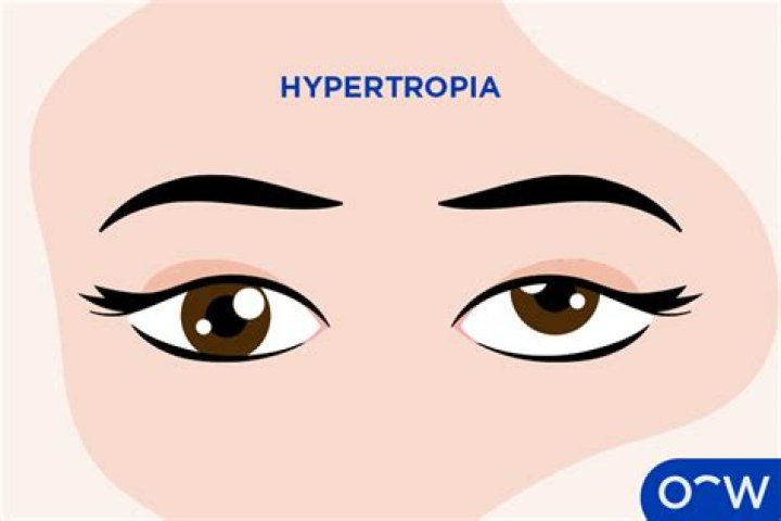 What does Hyperphoria mean? | ContextResponse.com