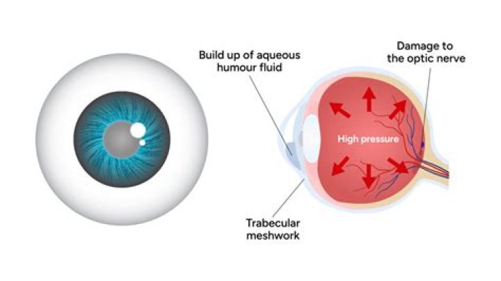 What is an aqueous shunt?