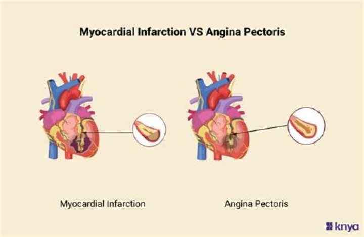 What is the difference between myocardial infarction and angina pectoris?