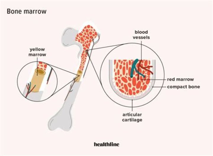 Which term means inflammation of the bone marrow and adjacent bone?