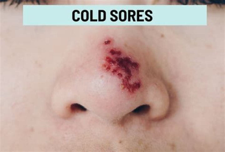 Why do I get cold sores under my nose?